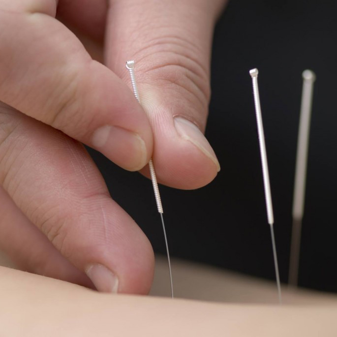 Acupuncture